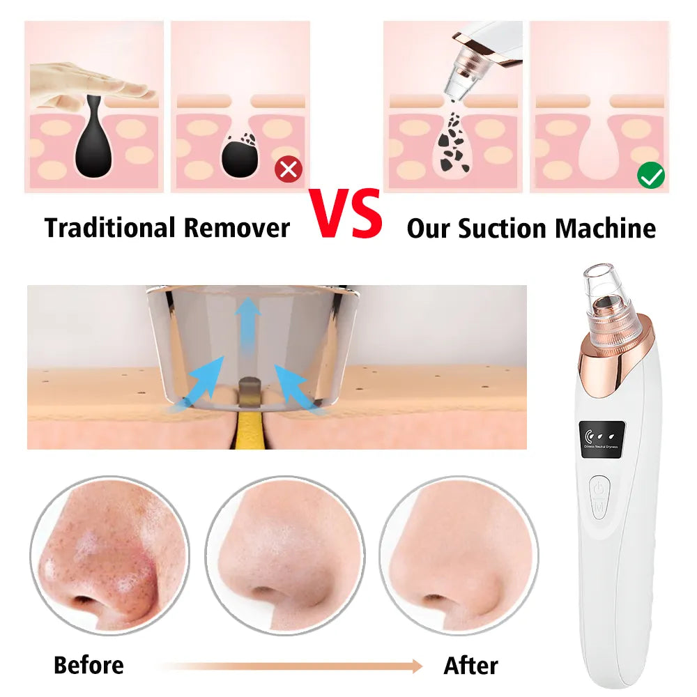 Blackhead Remover/Vacuum Pore Cleaner Tool Skin Care