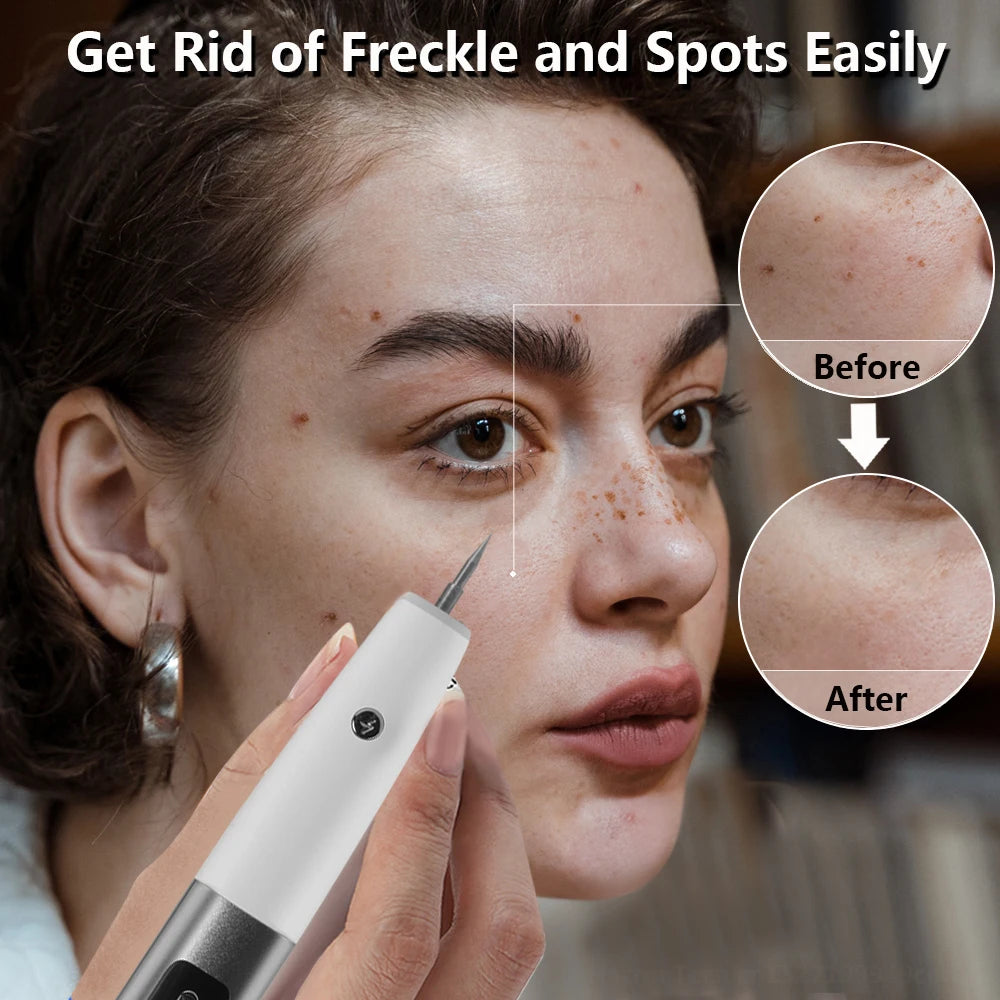 Mole Remover for Dark Spot and Freckle Removal