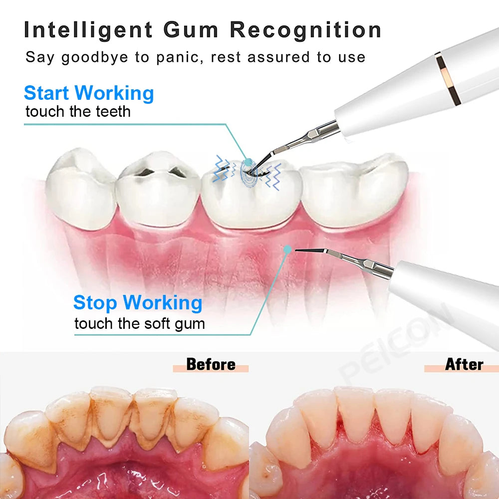 Ultrasonic Dental Scaler for Teeth Tartar Stain