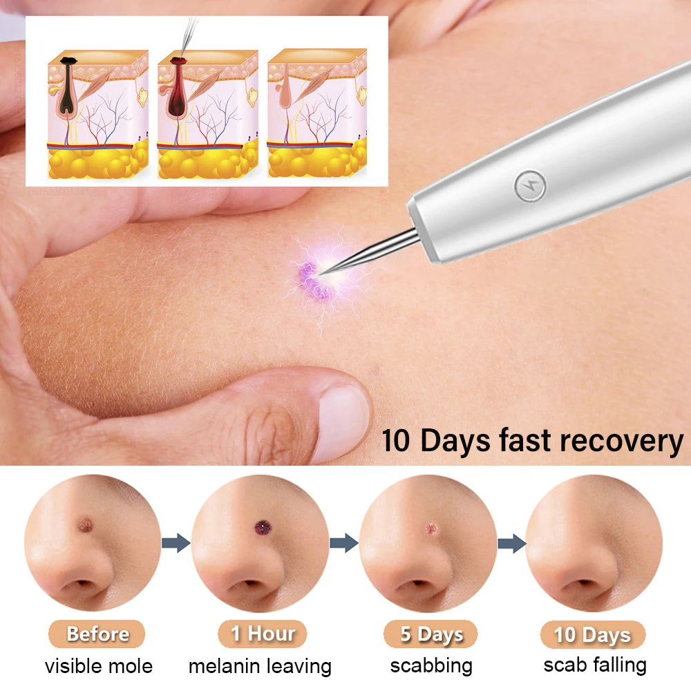 Skin Tag Remover Laser Plasma Pen