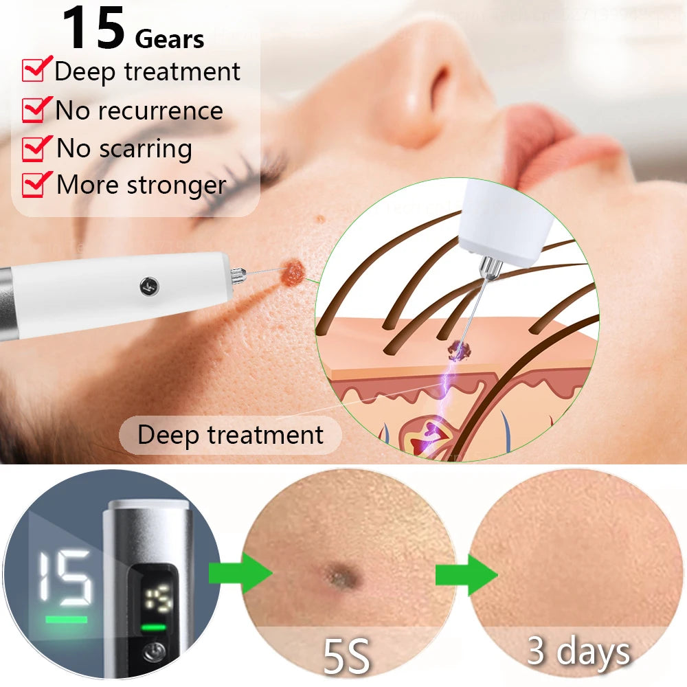 Mole Remover for Dark Spot and Freckle Removal